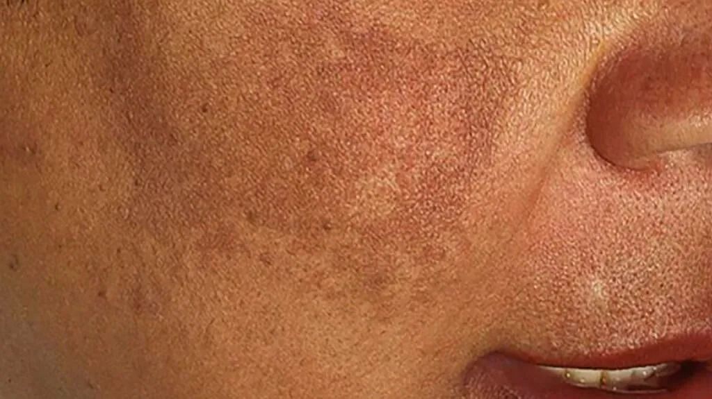 Hyperpigmentation (Image via Getty Images)
